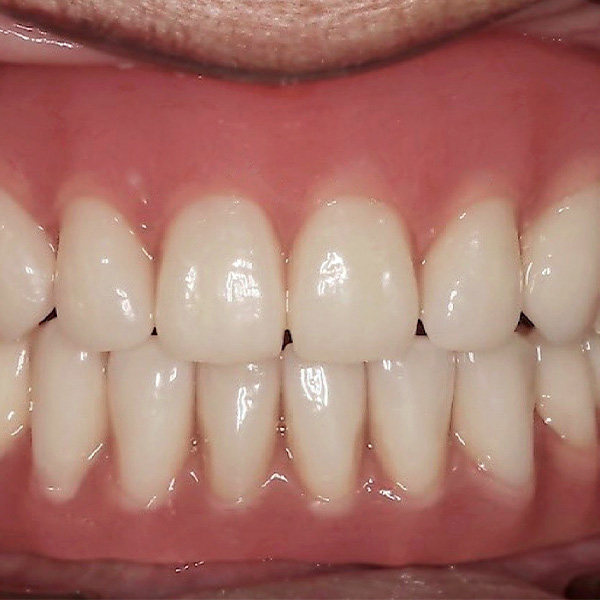 New restoration: Surface texture, shape and shade were age-appropriate after the integration.