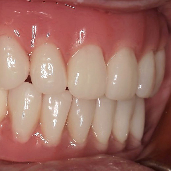A Class III became a Class I (neutral bite position) as a result of the realignment.