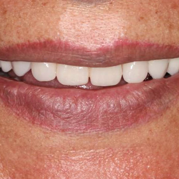 RESULT: The course of the incisal edge harmonized with the lower lip, which no longer protruded forward.