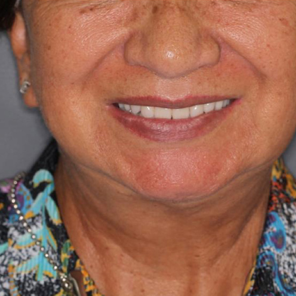 The patient with her new full denture restoration.