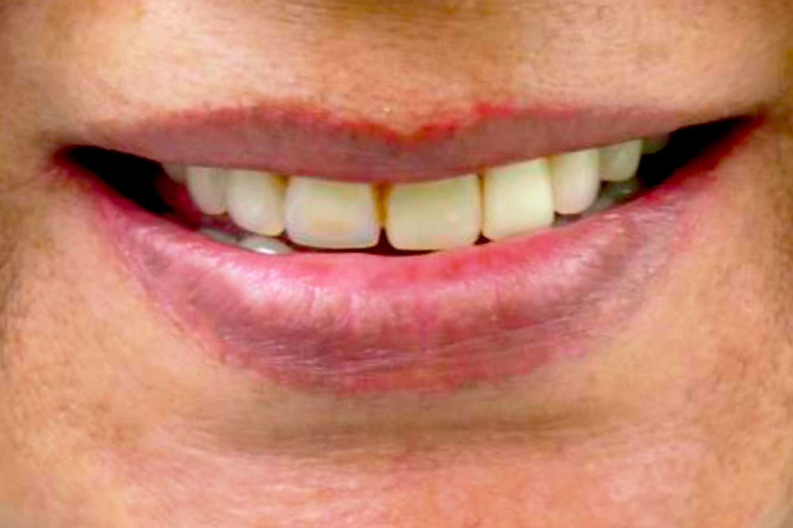 The initial situation with the uneven line of the incisal edges in the upper jaw.