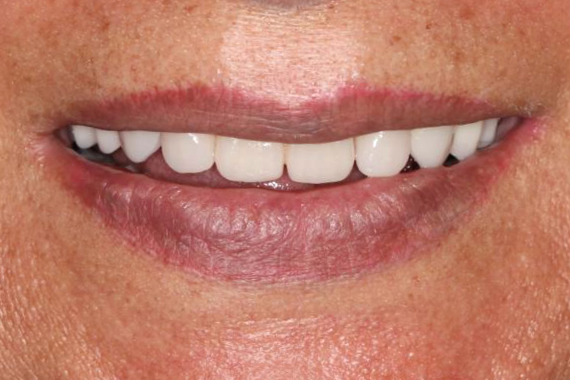 RESULT: The course of the incisal edge harmonized with the lower lip, which no longer protruded forward.
