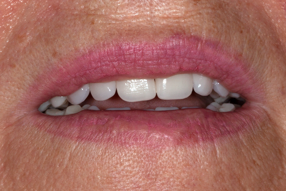RESULT: The patient was very happy with the naturalness of the new restoration.