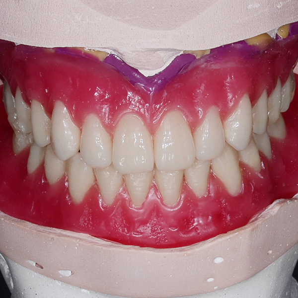 Based on the bite registration of the setups, the maxilla could be accurately rearticulated.