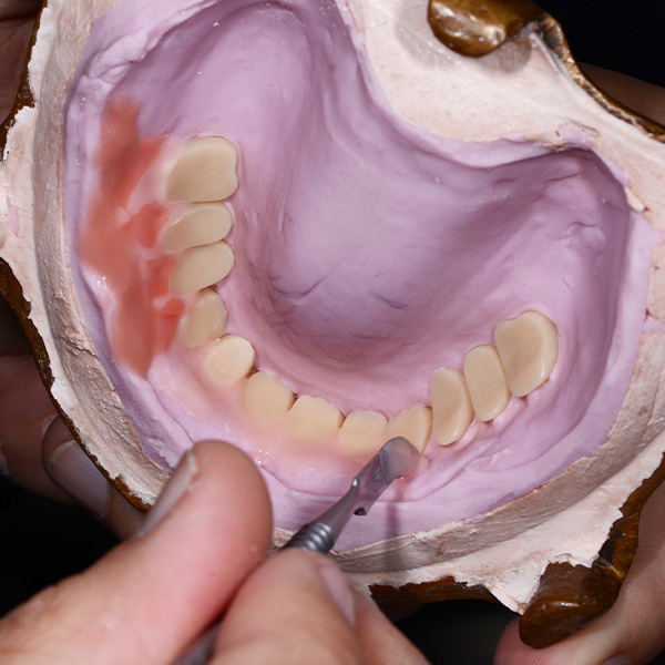 The vestibular plate was customized with several synthetic material layers in different gingival shades.