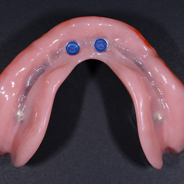 The bridge and attachments were integrated by polymerization of the synthetic material base.