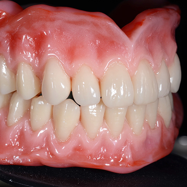 The finished restorations after elaboration and polishing in static occlusion.