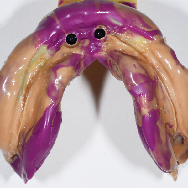 A custom-made tray was used in the mandibular for a mucodynamic fixation impression.