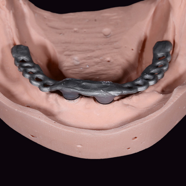 A simple bar construction was poured and fixed with synthetic material to the abutments.