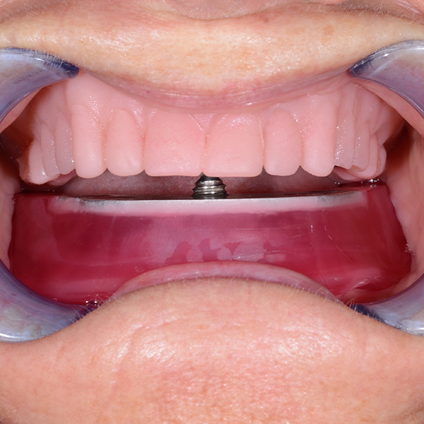 The centric and temporomandibular movements were recorded with the gothic arch.