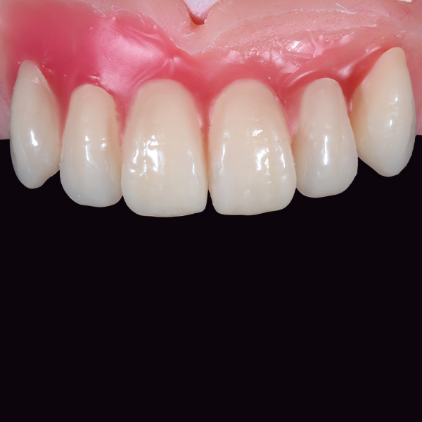 The esthetic zone was reduced, replaced with VITAPAN EXCELL, and finally tried in.