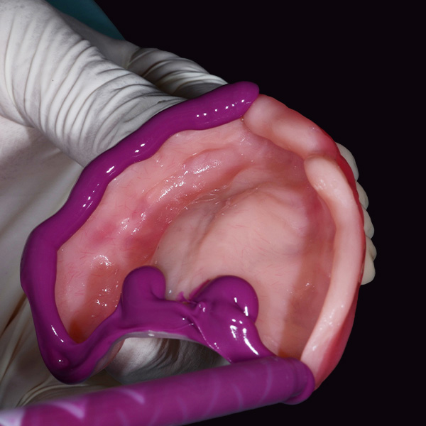 After the try-in, a mucodynamic impression with setup was taken in the maxilla.