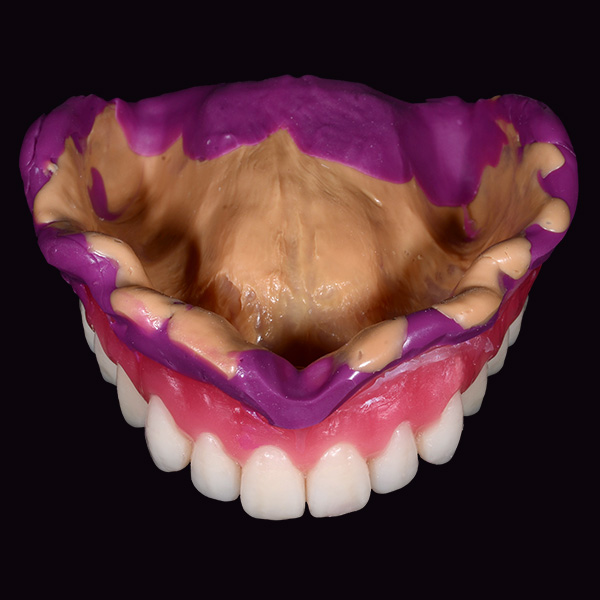 The final occlusion-adjusted, mucodynamic impression in the duplicated denture base.