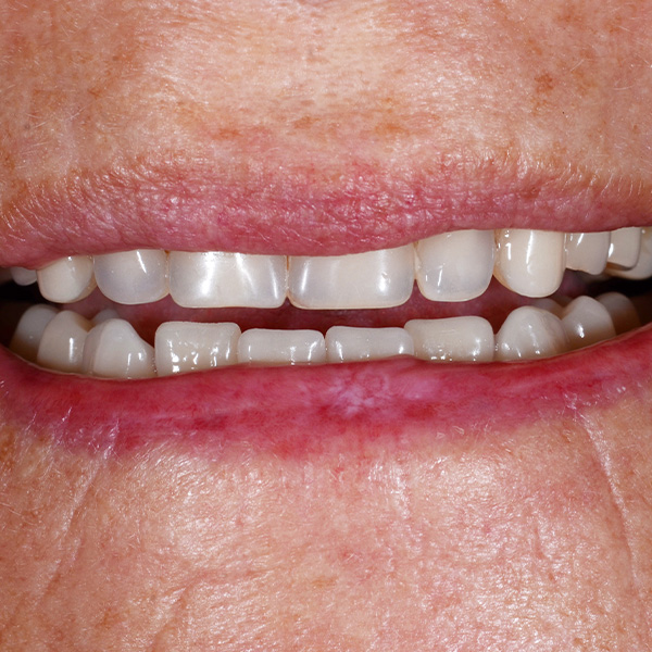 The insufficient restorations showed a midline displacement and functional disharmonies.