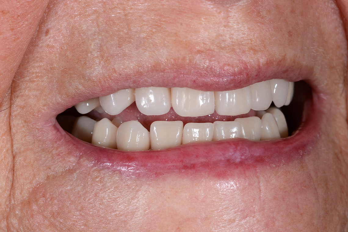 RESULT: The patient was very happy with the naturalness of the new restoration.