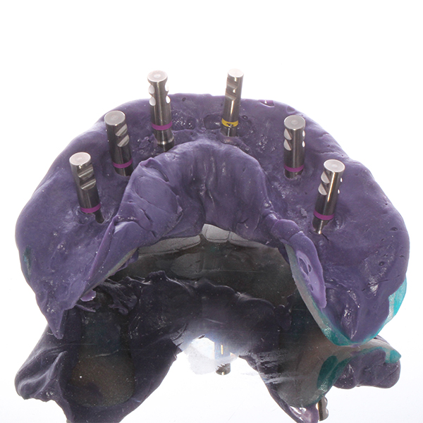Para la toma de impresiones de fijación en los maxilares superior e inferior se utilizó una cubeta cerrada.