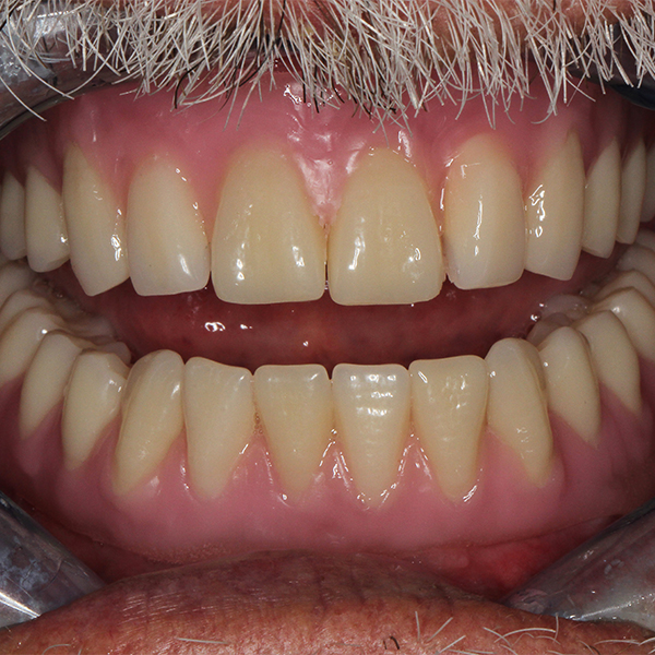 The wax setup during clinical try-in in the patient's mouth.