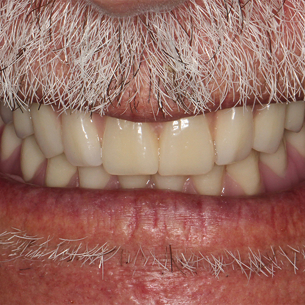 Function, facial expression, phonetics, and esthetics, were carefully verified on the patient.
