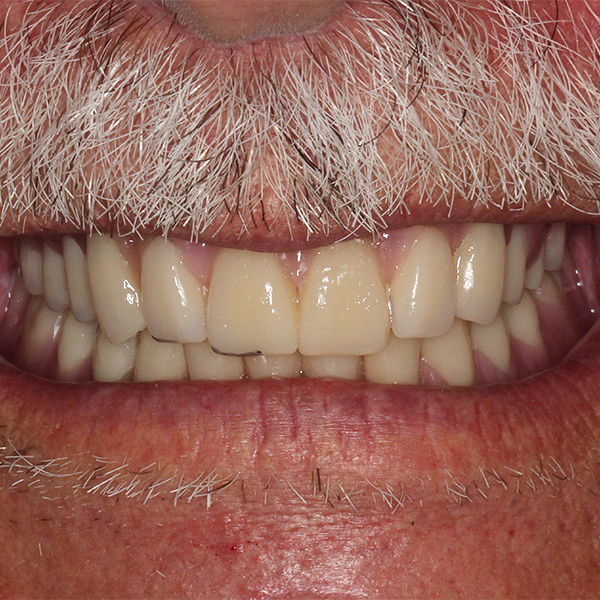 The incisal excess at 12 and 22 was marked so that corresponding changes could be made.