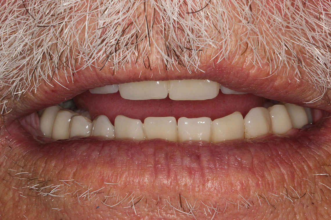 RESULT: Finally, when opened slightly, it was possible to see a harmonious incisal edge gradient.