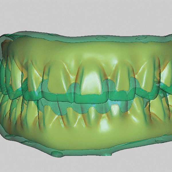 The setup was shrunk in the CAD software so that an anatomically reduced substructure could be constructed.