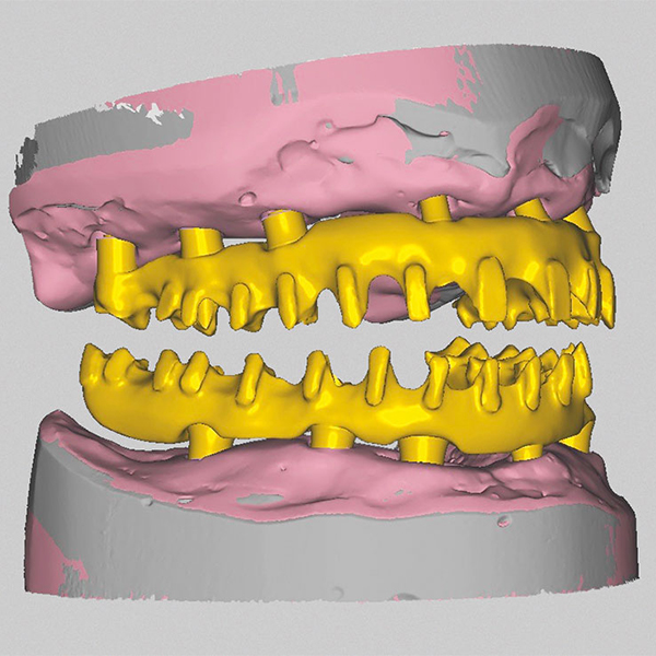 The substructures (after controlled shrinkage) harmonized from a denture perspective with the setup.