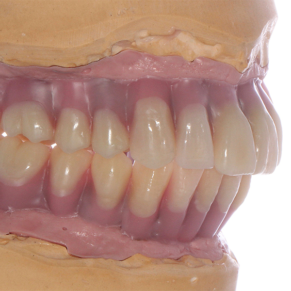 Using a silicone key, the setup was transferred to the substructures and the base modeled in full using wax.