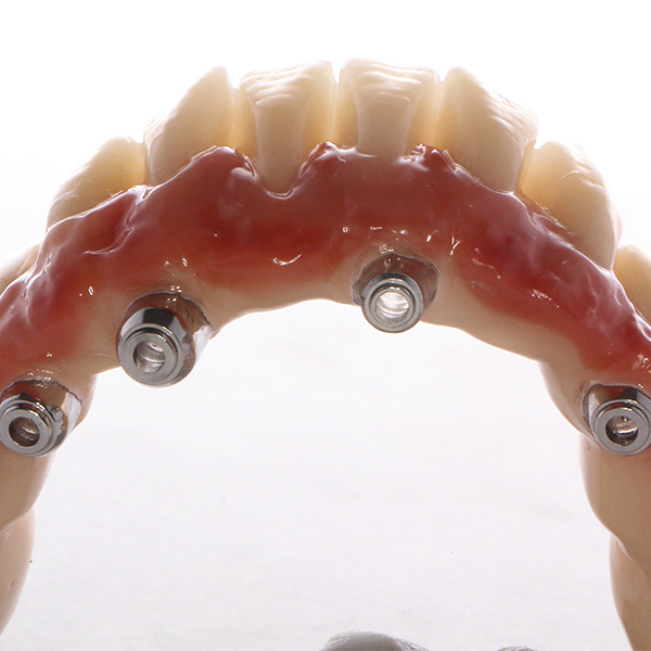 The lifelike setup and the custom gingival gradient provide for a natural appearance.