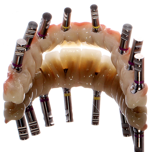 The finalized restoration with screwed-on implant analogs was very light.