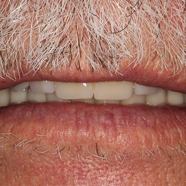 In the occlusal rest position, an optimum interplay was also visible between the lip line and incisal edges.