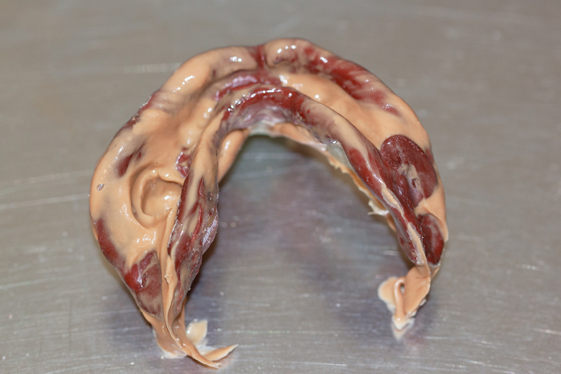 Two-phase mucodynamic impressions were taken of the upper and lower jaw.