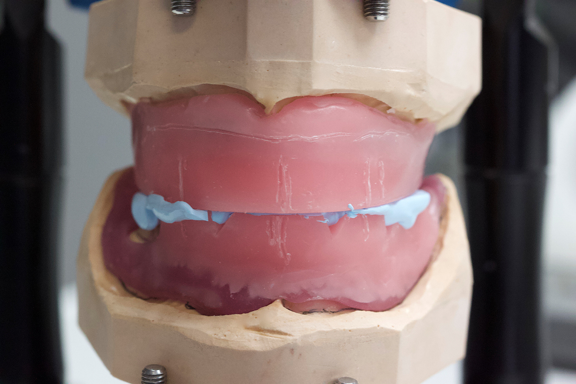 The master models were articulated using jaw relation determination.