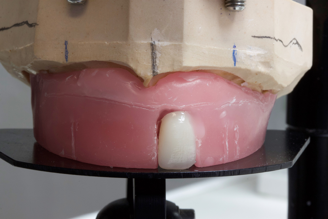 Gracias a la morfología del diente VITAPAN EXCELL, el montaje tuvo lugar automáticamente.