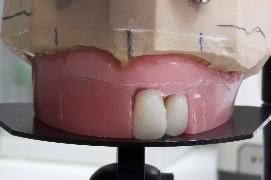 Tooth 22 was slightly inclined in the palatal direction to facilitate an individual appearance.