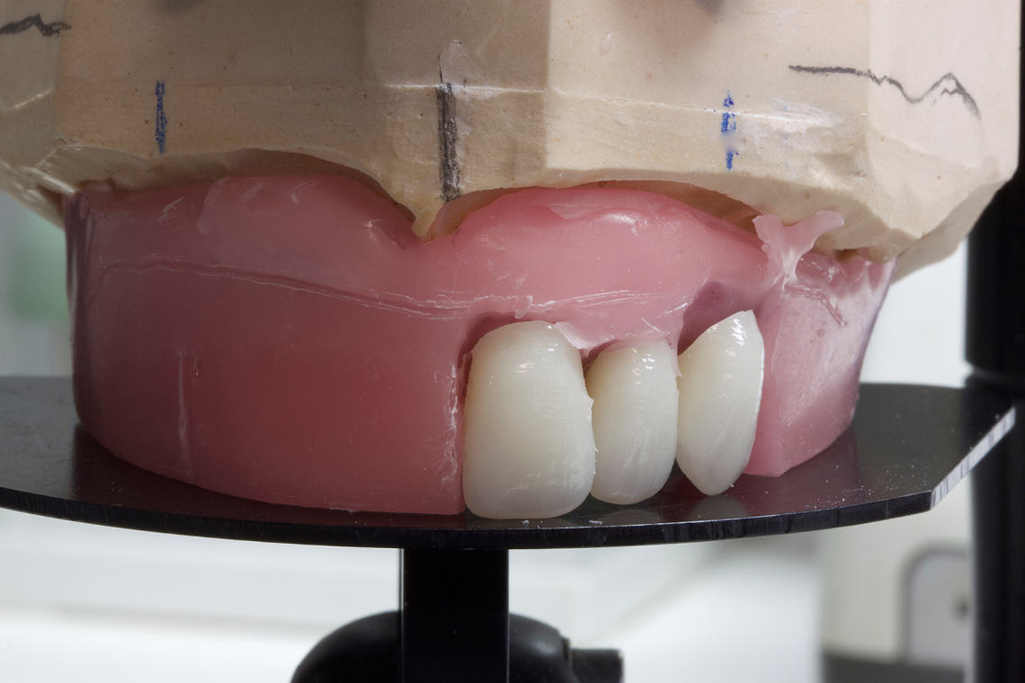 La estética integrada permitió realizar con rapidez el montaje de los dientes anteriores.