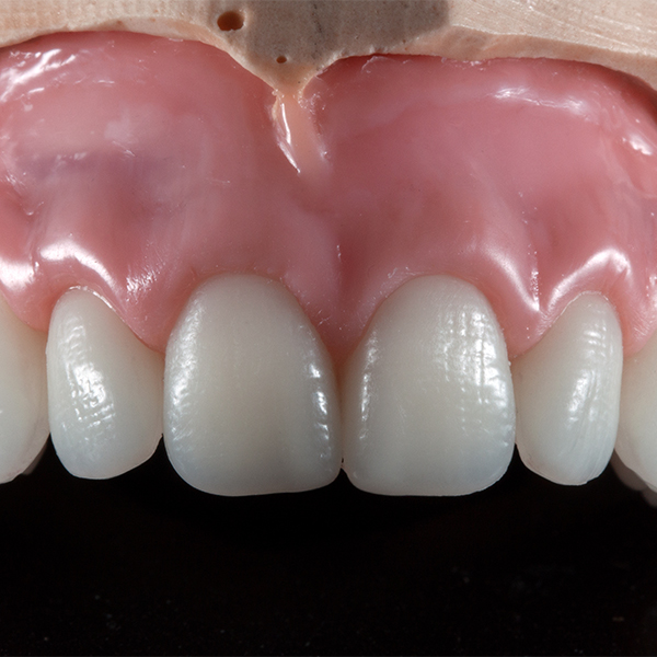 The upper denture with modeling complete and the natural play of light of VITAPAN EXCELL.