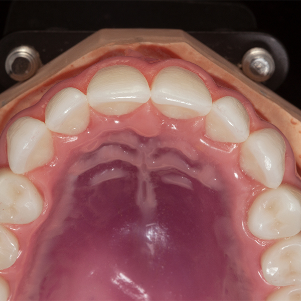 The palatal anatomy was also precisely simulated for try-in.