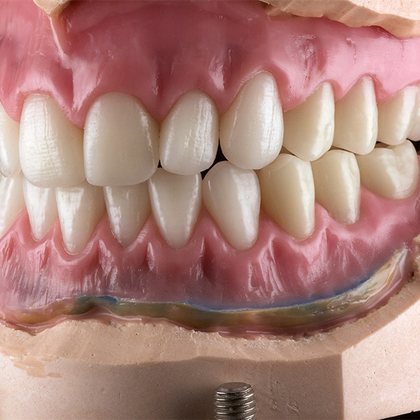The upper and lower denture with modeling complete in the articulator.
