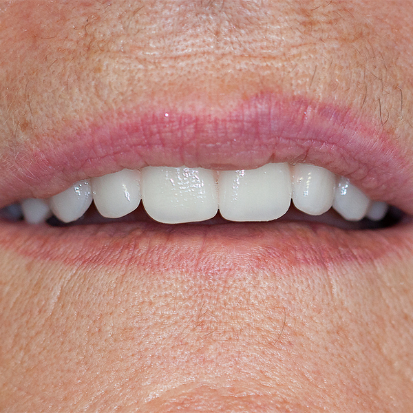 The patient was already delighted with the esthetic result during try-in.