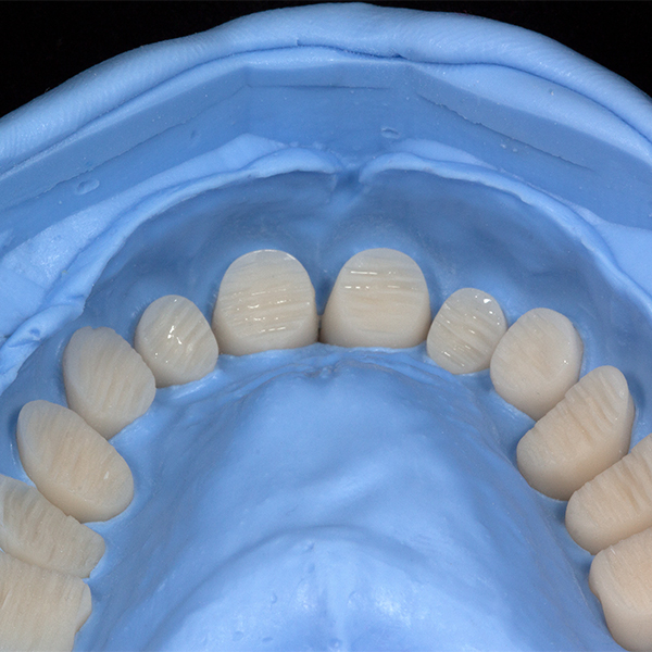Los dientes protésicos limpios y acondicionados, reposicionados en la llave de silicona.
