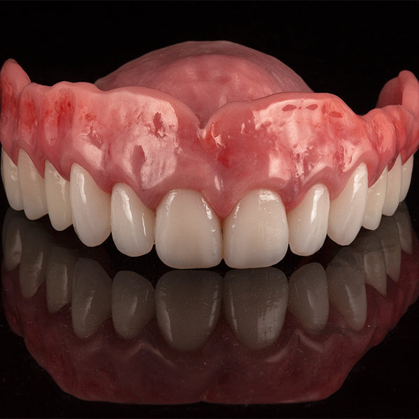 The completed, finished upper denture had a completely natural appearance.