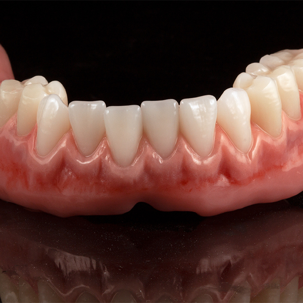 The slight overlap in the lower anterior area provided an individual appearance.