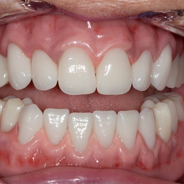 Both dentures could be integrated harmoniously in the oral cavity.