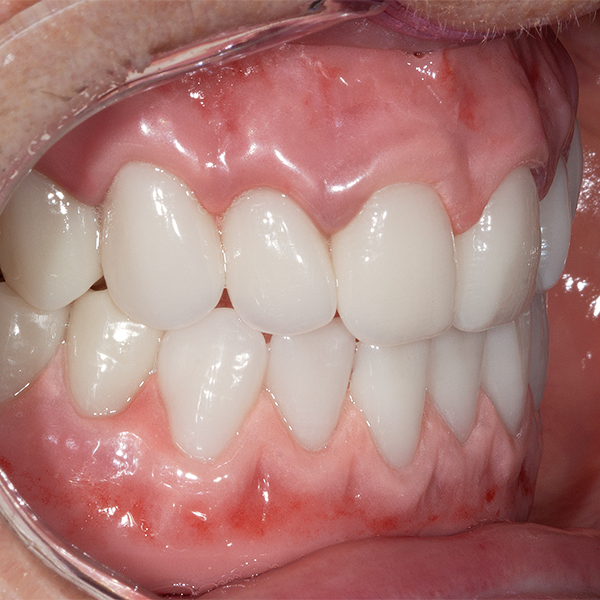 Los dientes preconfeccionados y la reproducción mucogingival formaron una unidad de aspecto natural.