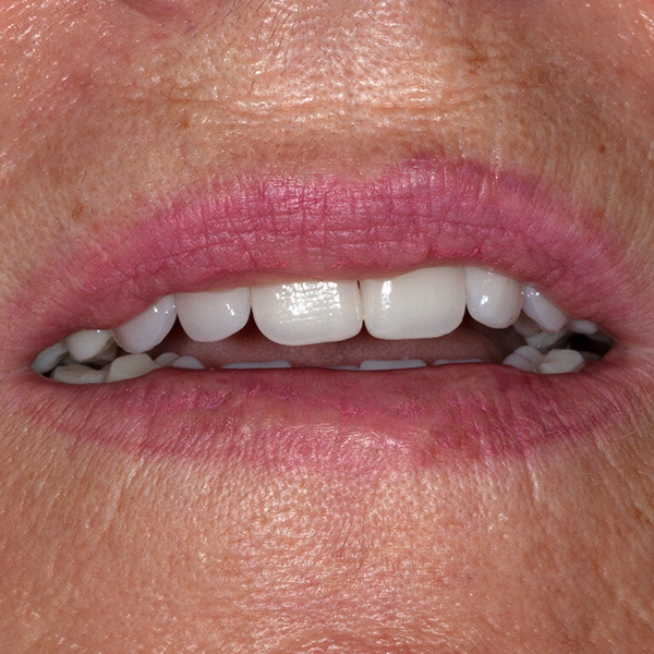 The patient was completely satisfied with the highly esthetic result.