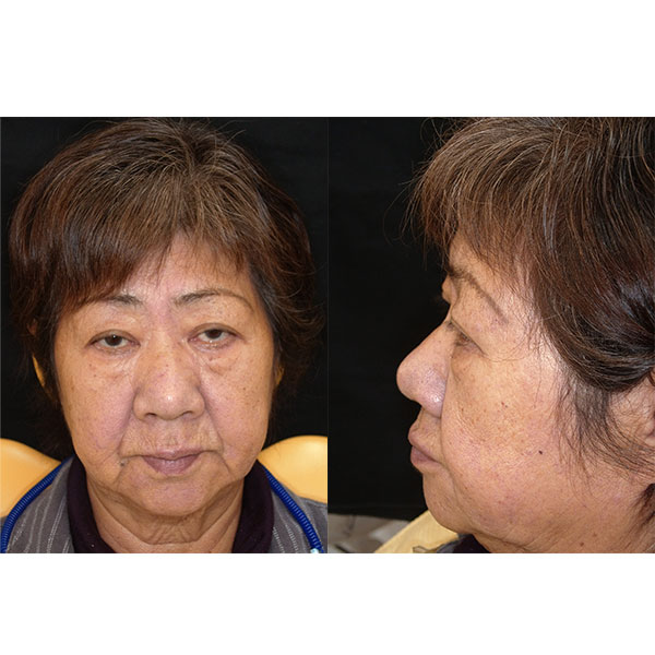 The initial situation with the facial features of the patient without dentures.
