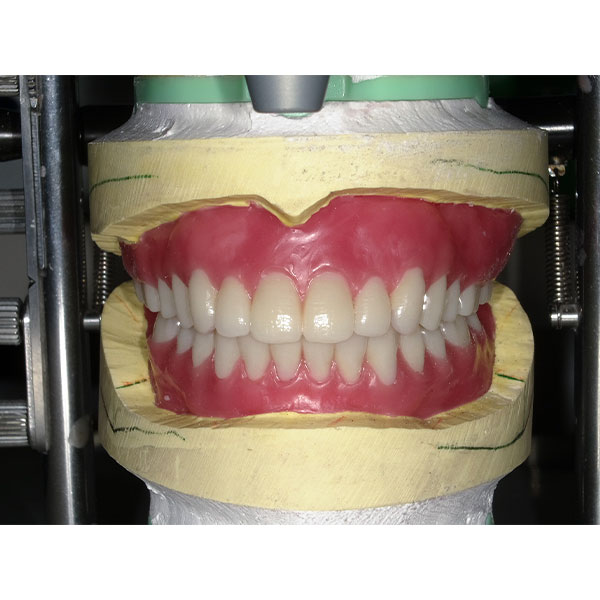 The setup in wax with the anterior tooth set VITAPAN EXCELL.