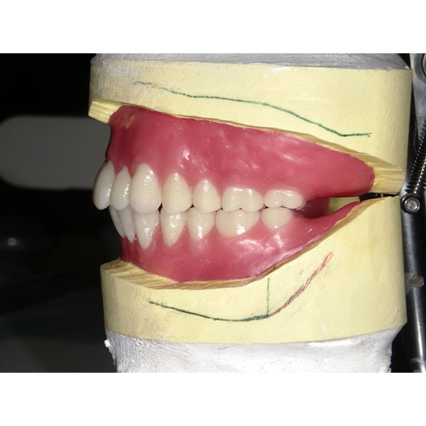 In the posterior region, the multi-functional VITAPAN LINGOFORM was used.