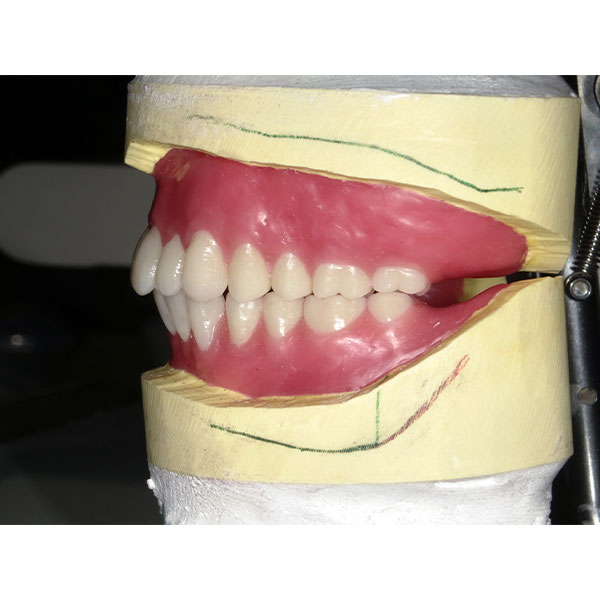 En el grupo posterior se utilizaron los dientes multifuncionales VITAPAN LINGOFORM.