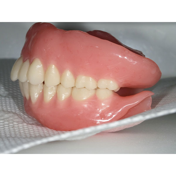 The full denture restoration after implementation in resin.
